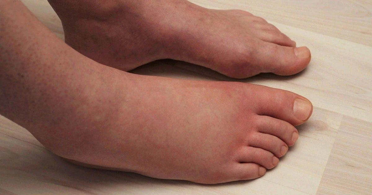 Le gonflement indolore des pieds