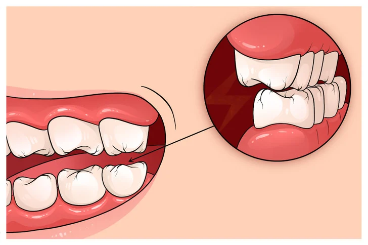 Le grincement des dents