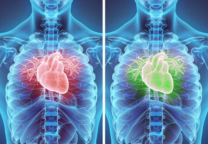 Le risque de développer une maladie cardiaque peut augmenter