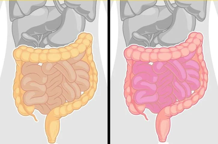 Les tomates peuvent déclencher votre syndrome du côlon irritable