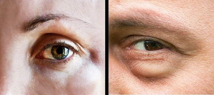 Les yeux qui démangent, les paupières gonflées