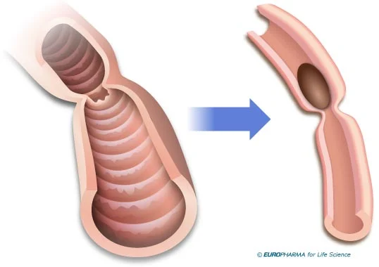 Obstruction intestinale