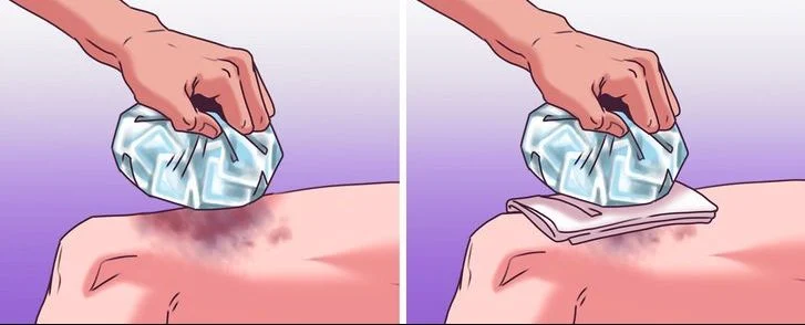 Poche de glace contre les gonflements