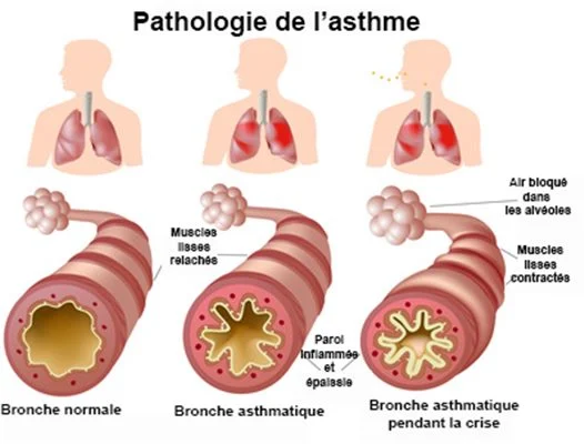 Sachez ce qui déclenche votre asthme