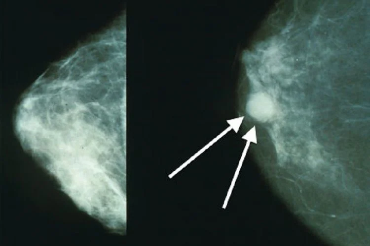 Signes précurseurs du cancer du sein