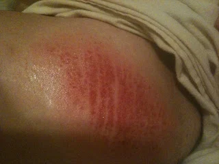 Irritation de la peau des cuisses
