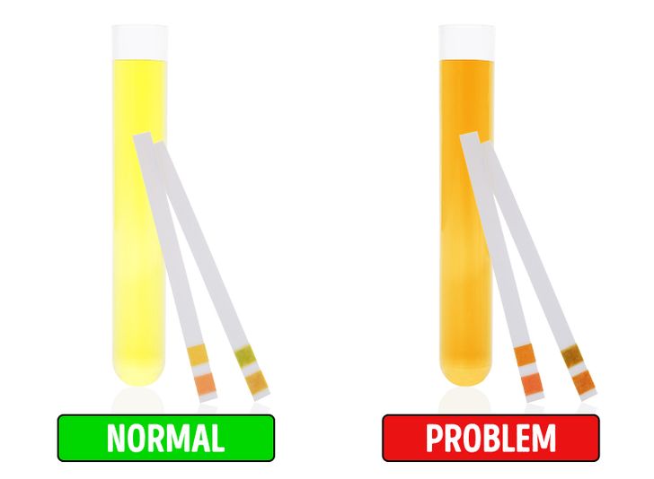 Votre urine peut avoir une couleur foncée