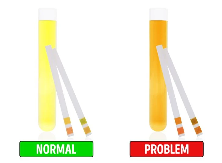 Votre urine peut avoir une couleur foncée