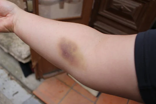 Vous pouvez trouver des ecchymoses sur votre corps