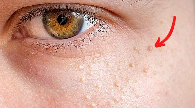 5 solutions pour se débarrasser des grains de milium grains de milium