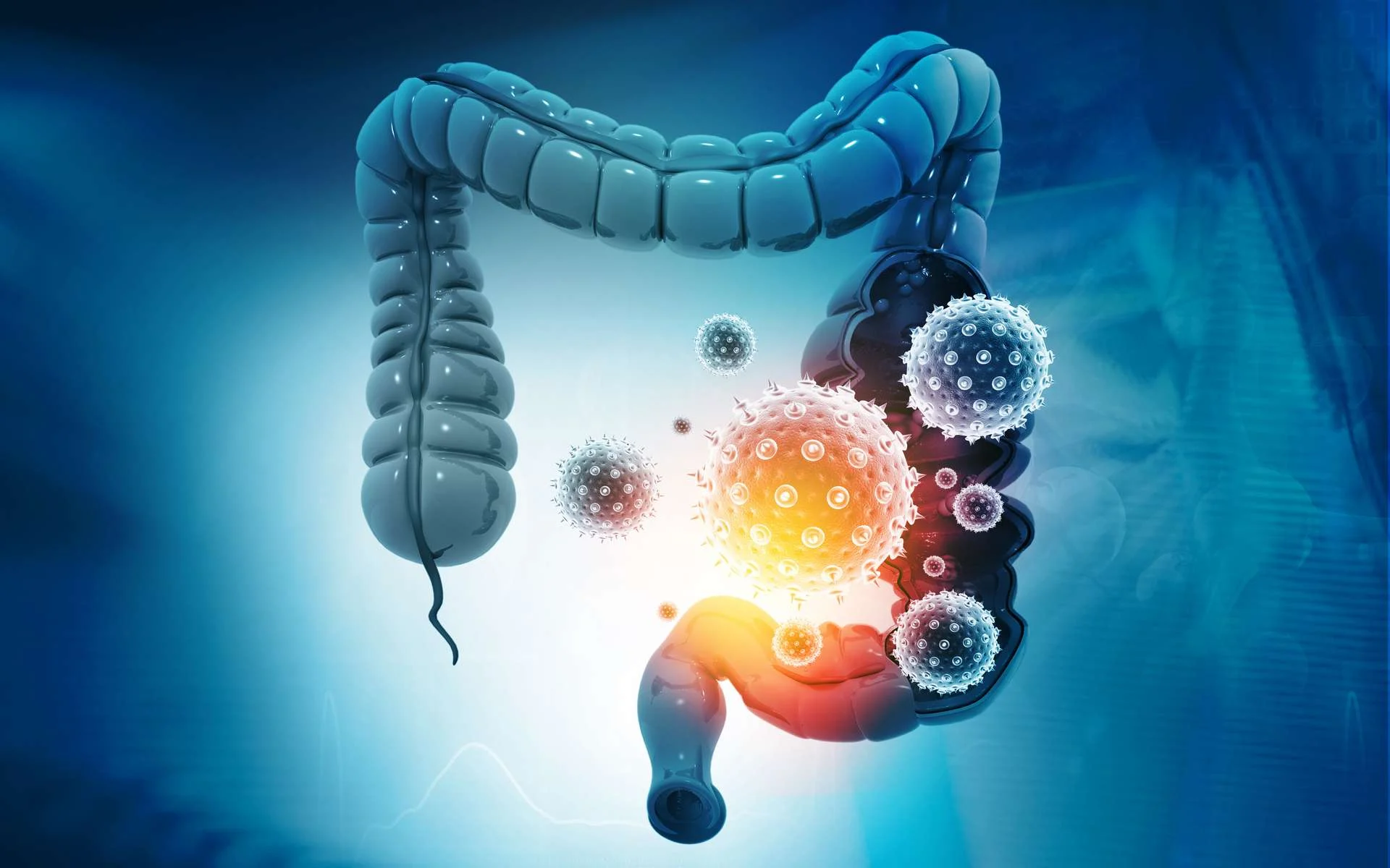 infection intestinale
