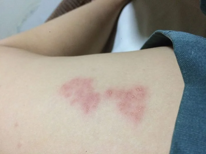  les irritations de la peau