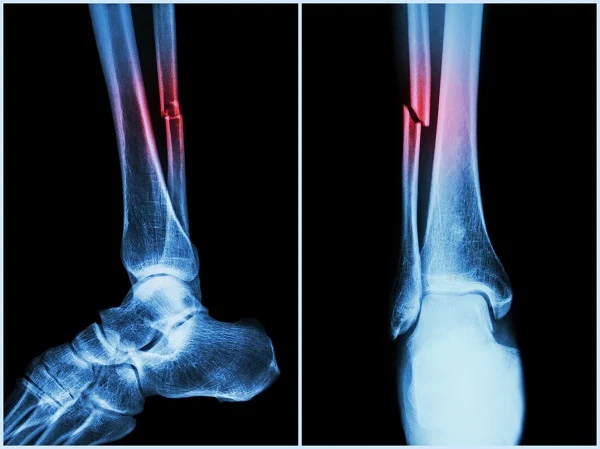 une de vos jambes peut devenir plus courte