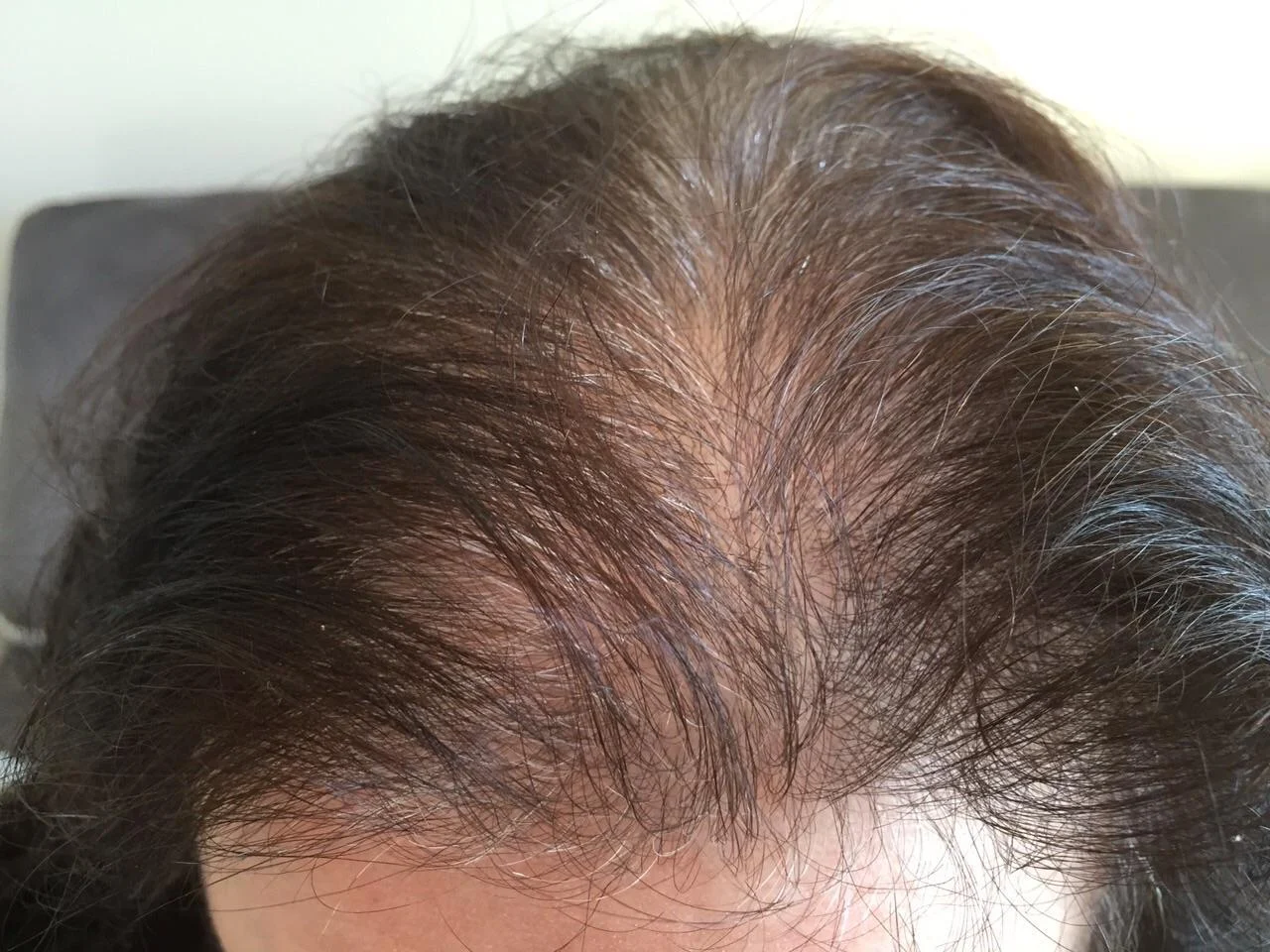 prédiabète diabète type 2 cheveux