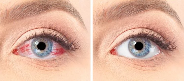 causes à l’origine des yeux secs