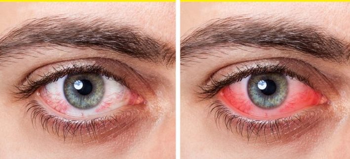 symptômes liés à la sécheresse des yeux