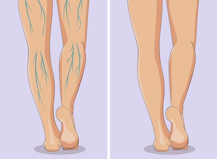 Apparition de varicosités dans les jambes