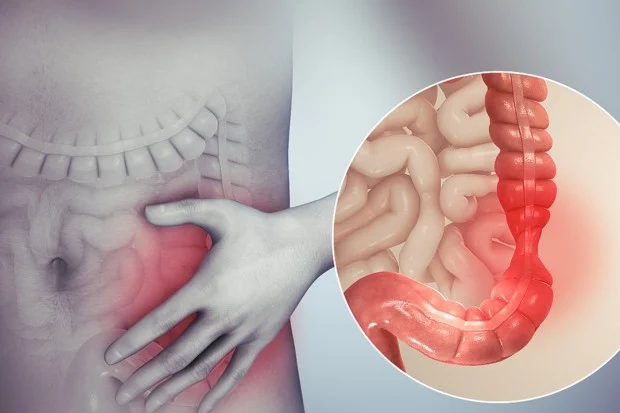 Le syndrome du côlon irritable (