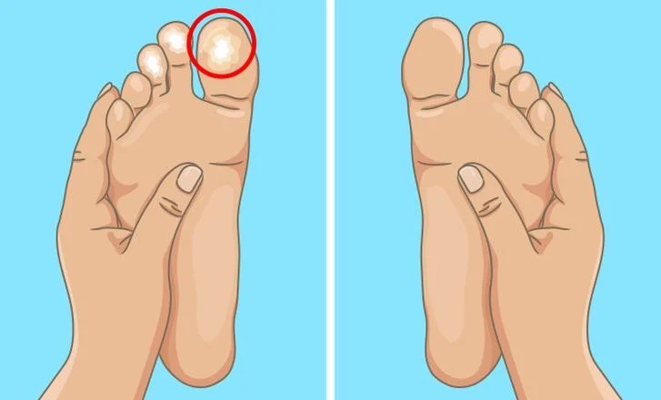 Ecchymoses inexpliquées sur les jambes
