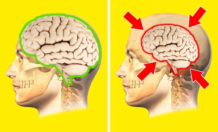 Le stress chronique peut rendre votre cerveau plus petit