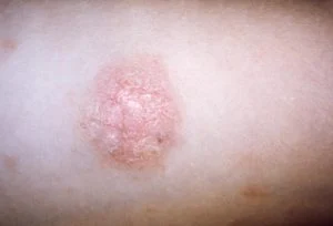 Pityriasis rosé