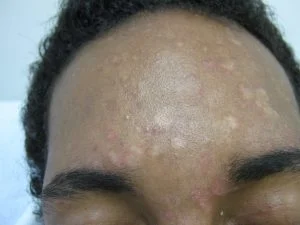 Pityriasis versicolor