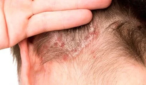 Les graines de moutarde peuvent lutter contre le psoriasis
