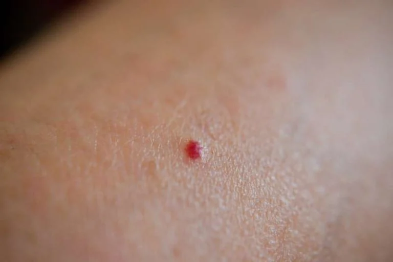 taches rouges peau