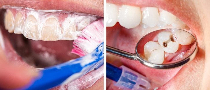 Se brosser les dents trop fréquemment peut provoquer des caries