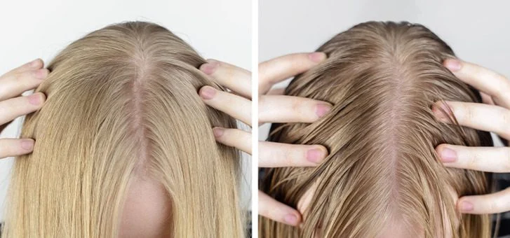 Vous pourriez subir une chute de cheveux plus importante