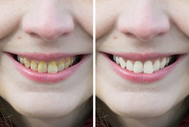 Cela peut affecter la couleur de vos dents