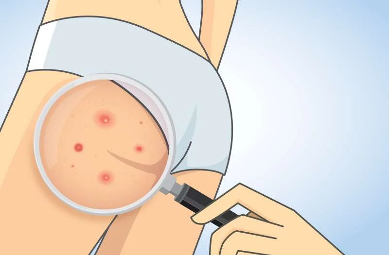 En ne portant pas de sous-vêtements, vous ne serez pas confrontée à l'acné des fesses