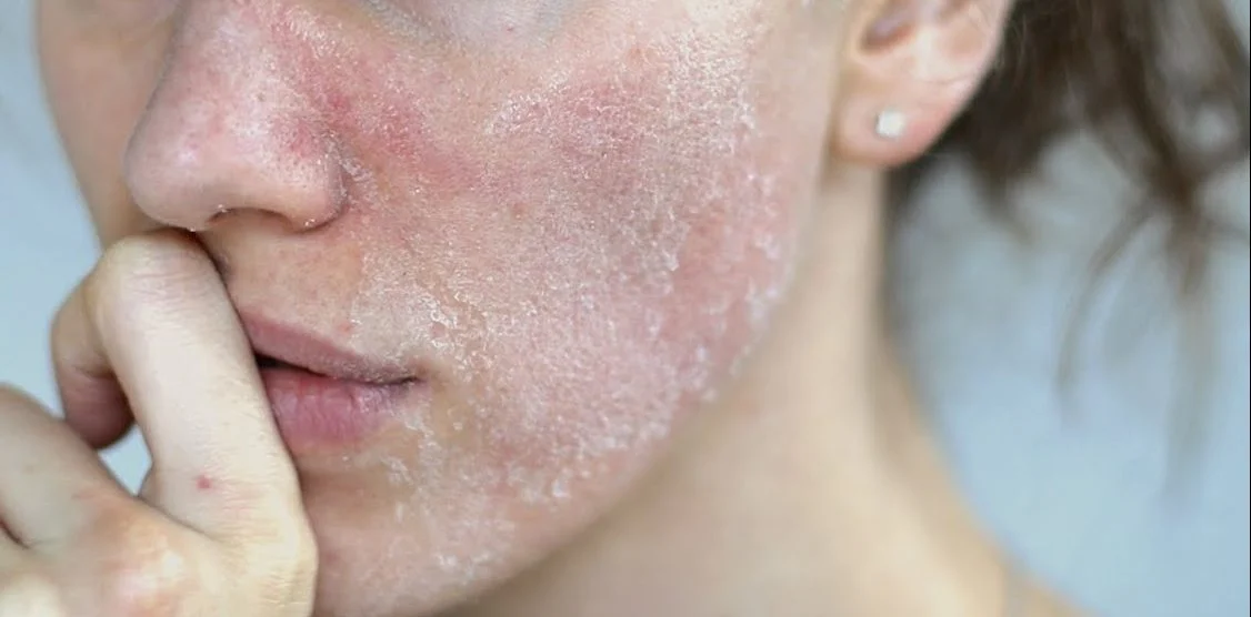 Le dessèchement de la peau
