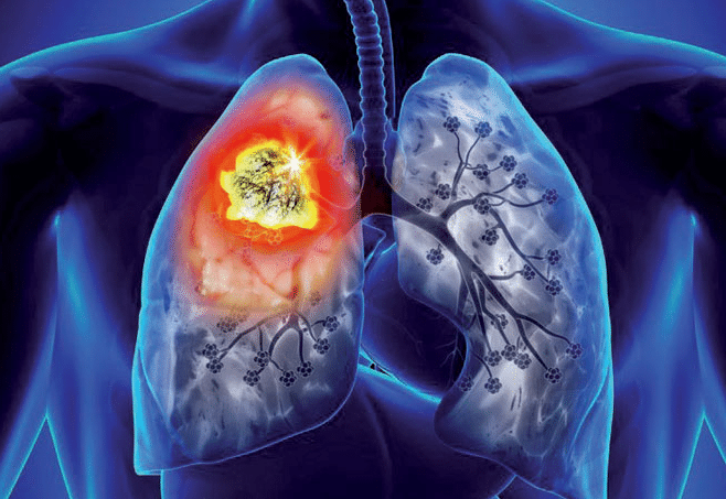 Cancer du poumon femme