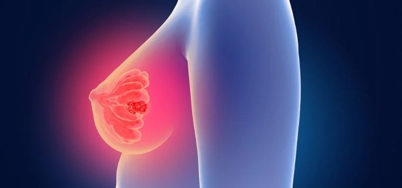 Cancer du sein femmes