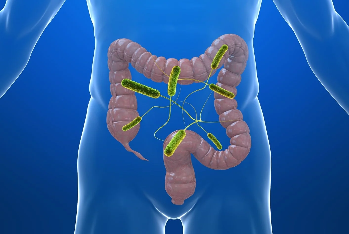 Cancer colorectal