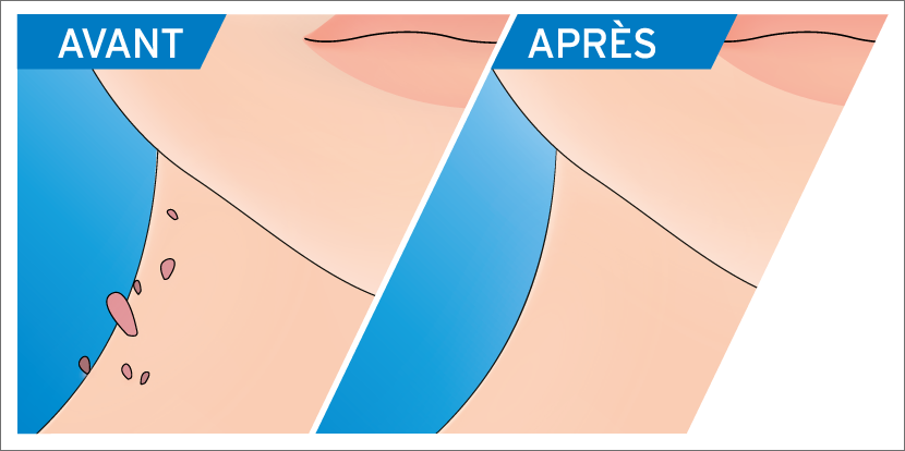 Se faire enlever les étiquettes de peau par un médecin est une procédure à faible risque