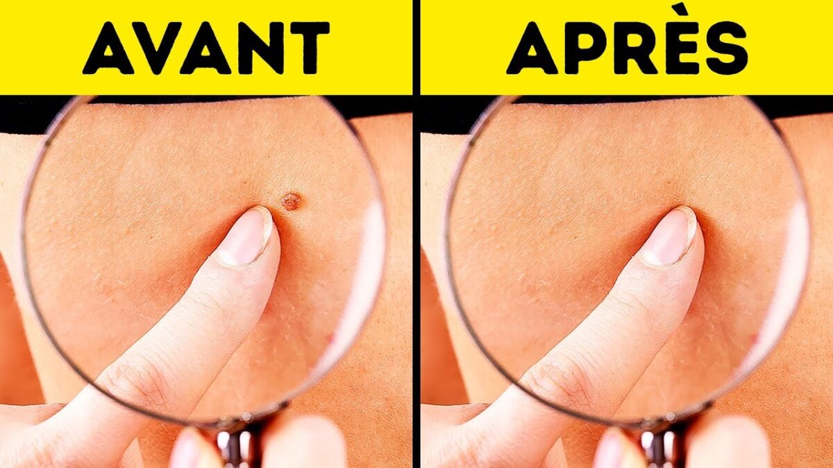 Les étiquettes de peau 4 techniques pour les retirer en toute sécurité 1 étiquettes cutanées peuvent être retirées directement dans le cabinet du médecin