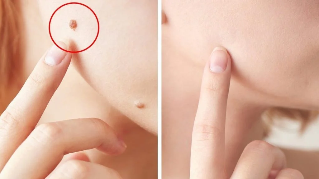 Les étiquettes de peau sont inoffensives