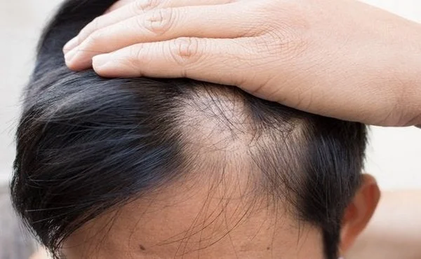 ananas Prévient la chute des cheveux et les rendre plus épais