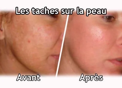 remèdes naturels contre les taches brunes