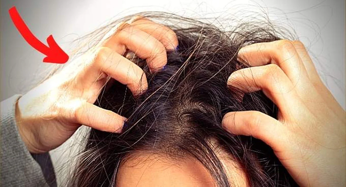 4 causes qui provoquent l’acné du cuir chevelu et comment la traiter de façon naturelle00 4 causes qui provoquent l’acné du cuir chevelu et comment la traiter de façon naturelle00