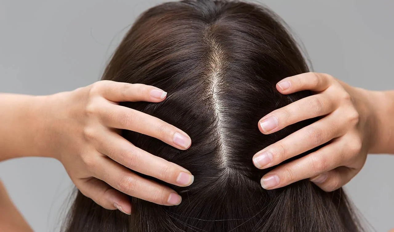 Astuces d'experts pour le traitement de l'acné du cuir chevelu