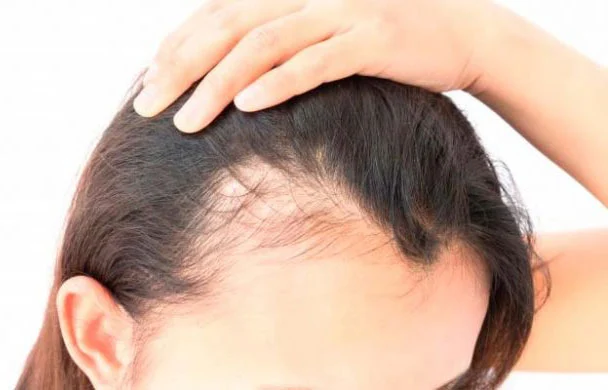 calvitie perte de cheveux
