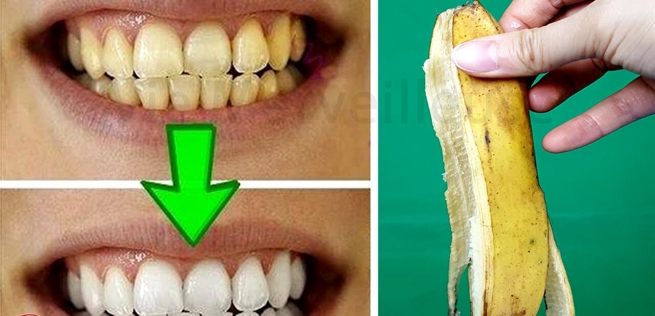 La peau de banane blanchit-elle les dents