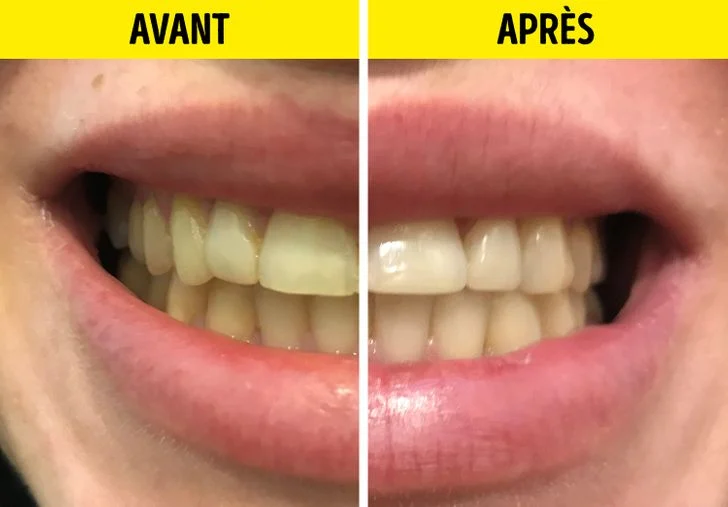 dentiste blanchir les dents