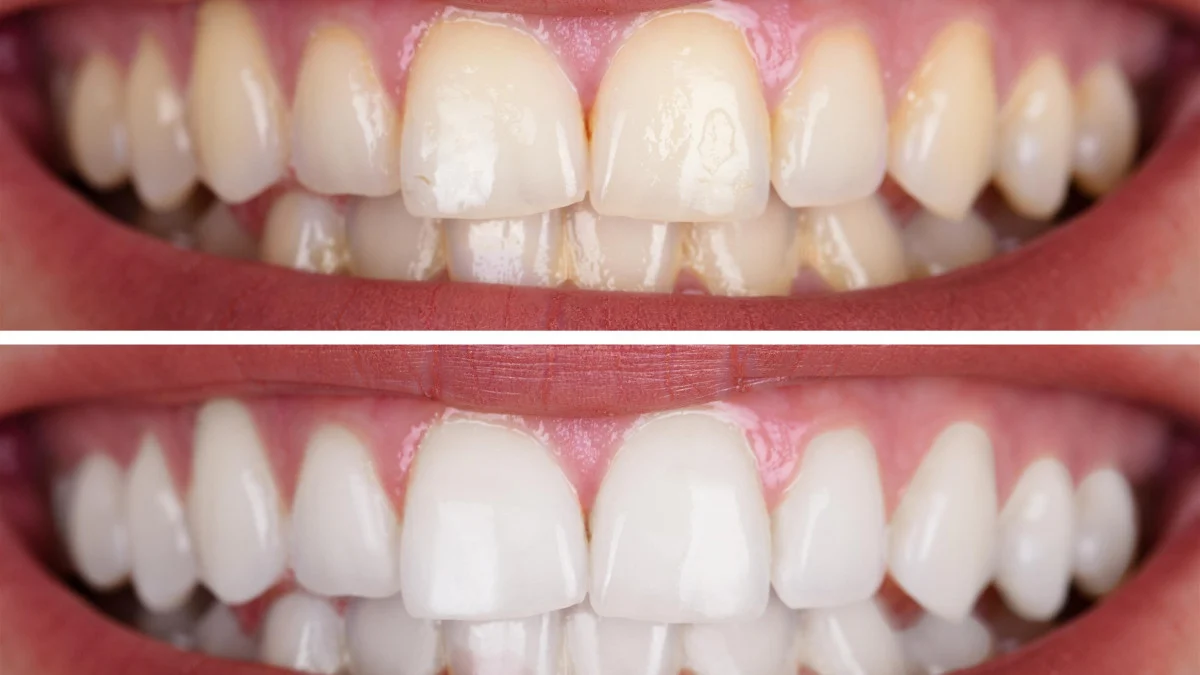 Alternatives au blanchiment des dents