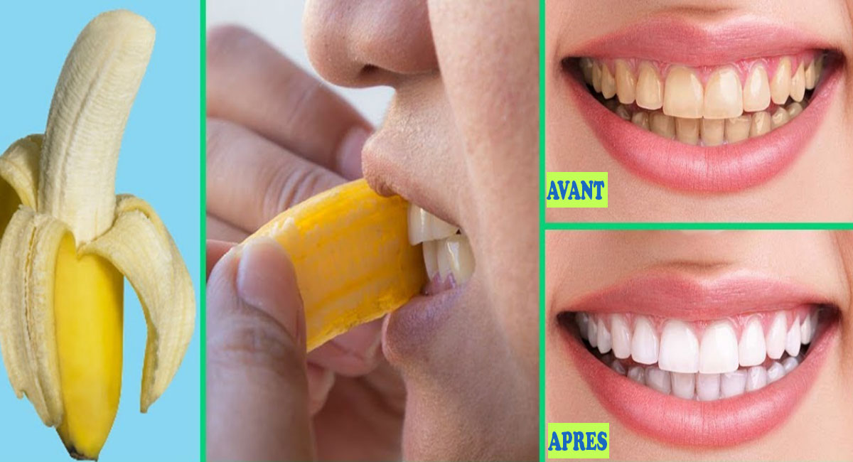 Comment blanchir ses dents avec une peau de banane dents