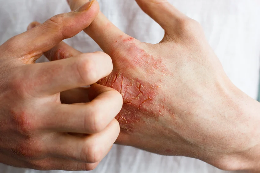 Facteurs de risque de l'eczéma