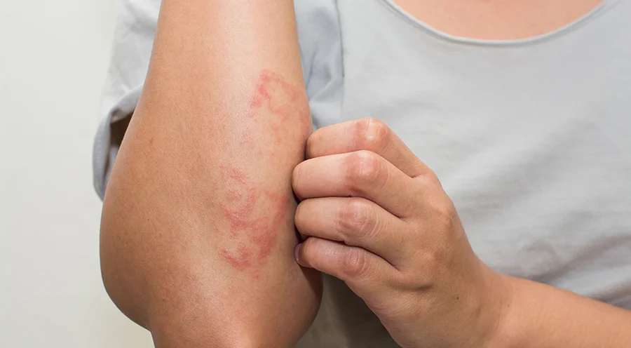 Causes de l'eczéma